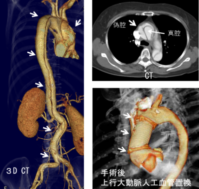 スタンフォードA型大動脈解離の３D-CT画像