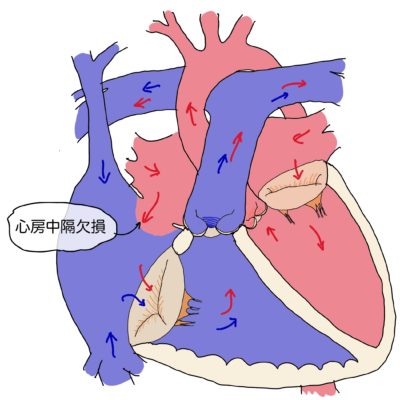 心房中隔欠損と書かれた心臓の図。左右の心房間に欠損孔があり、左心房から右心房へ血流が流れて右心系の拡大がある。