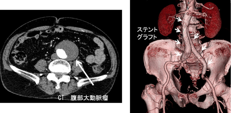 腹部大動脈瘤、ステント内挿術